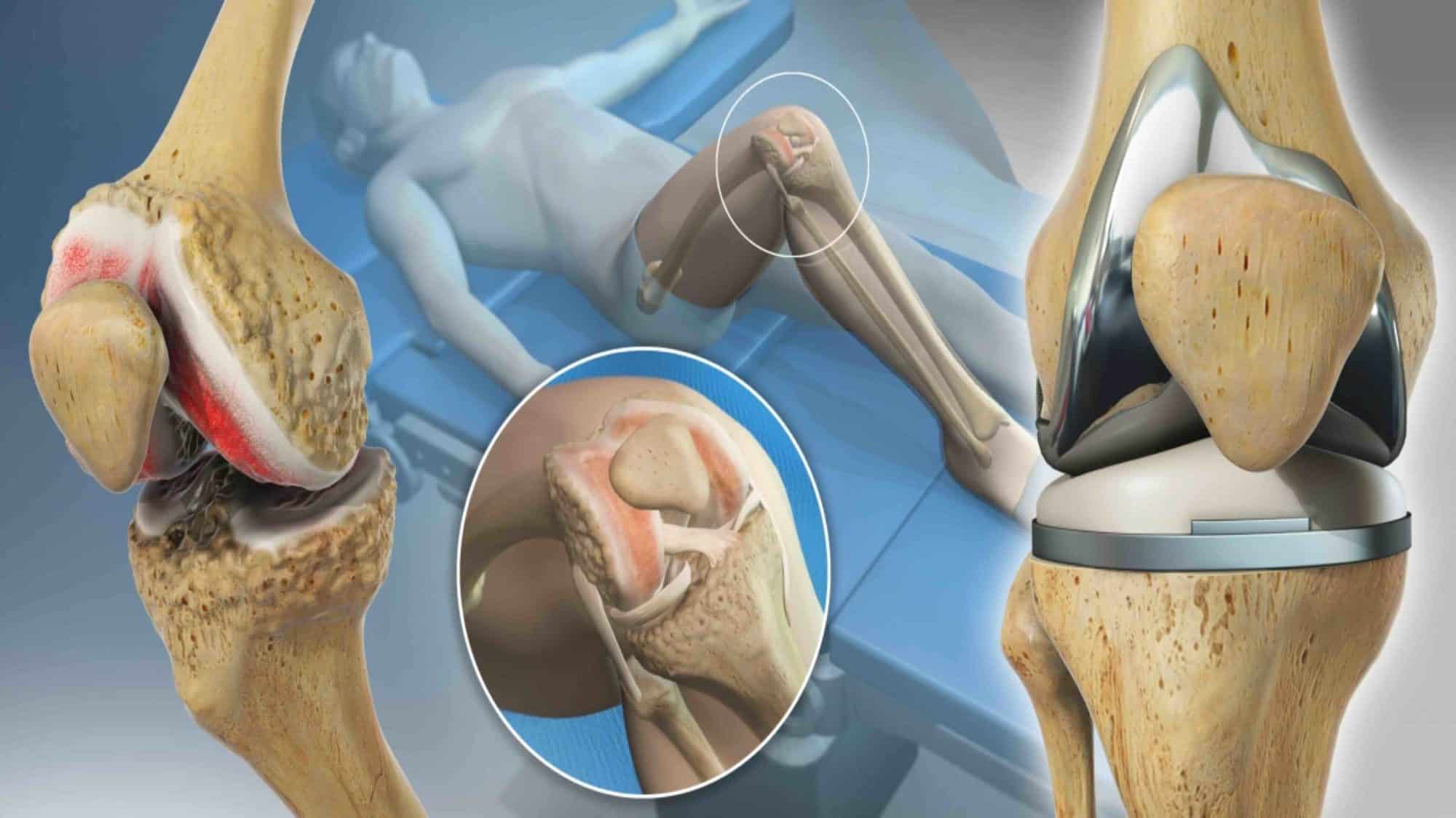 CIRURGIA DE PRÓTESE DE JOELHO