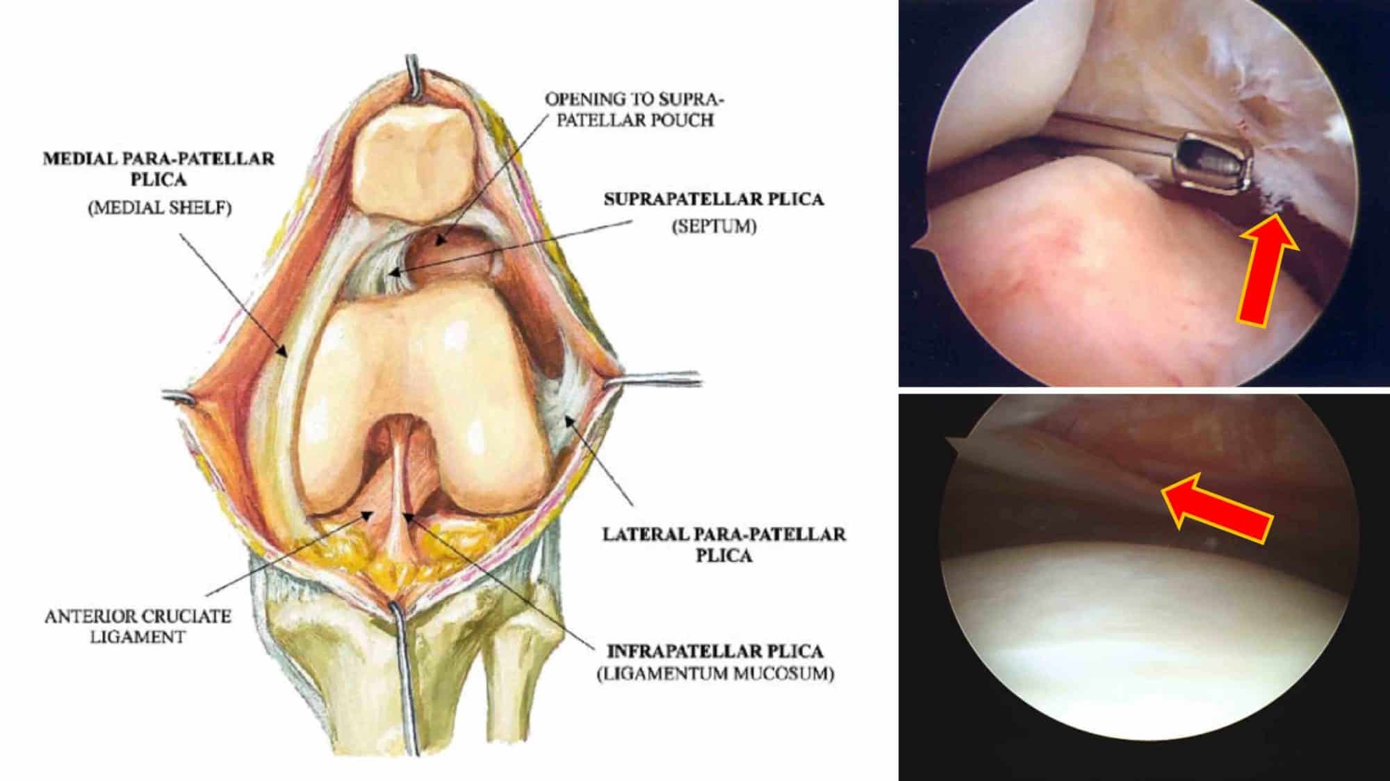 PLICA SINOVIAL JOELHO