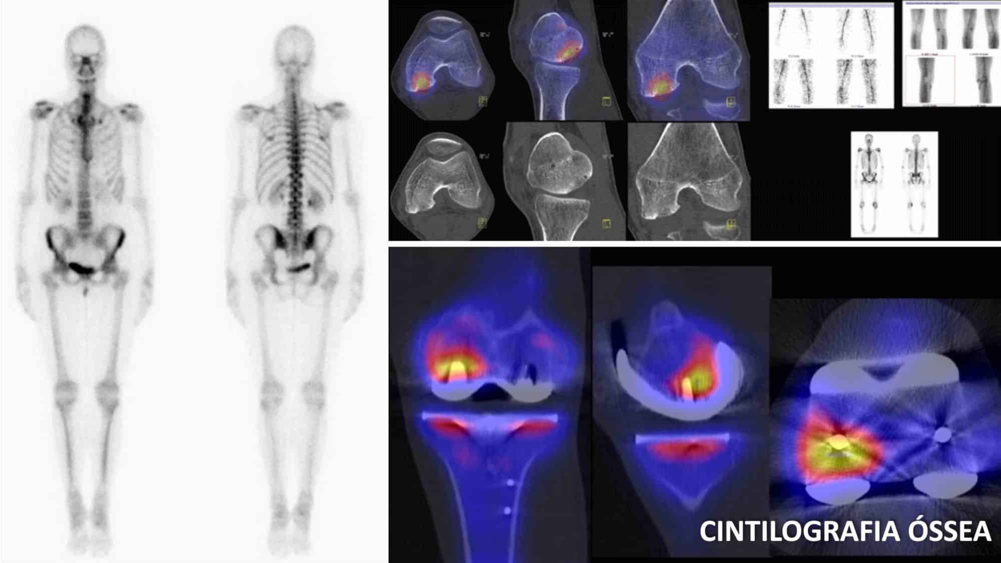 CINTILOGRAFIA ÓSSEA DO JOELHO