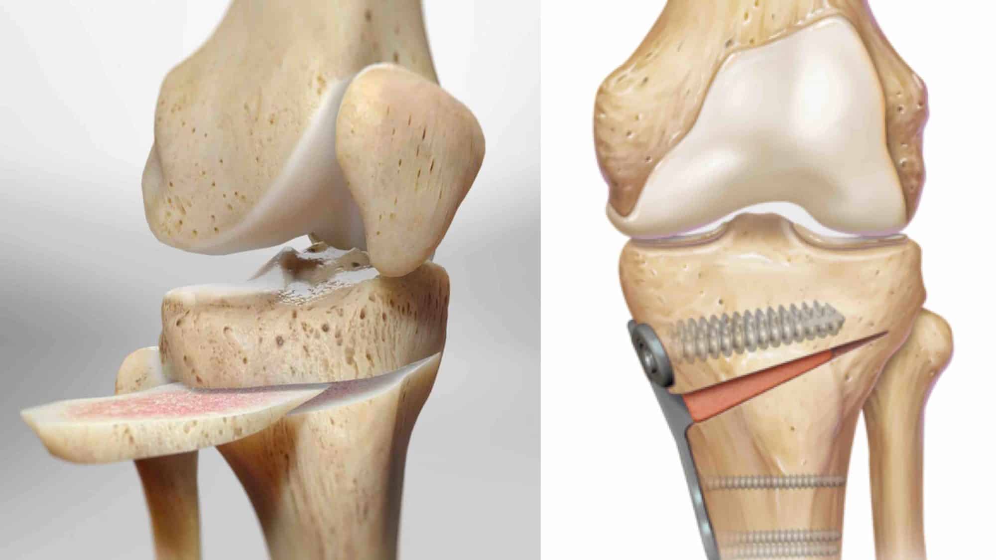 OSTEOTOMIA DO JOELHO - PROCEDIMENTO