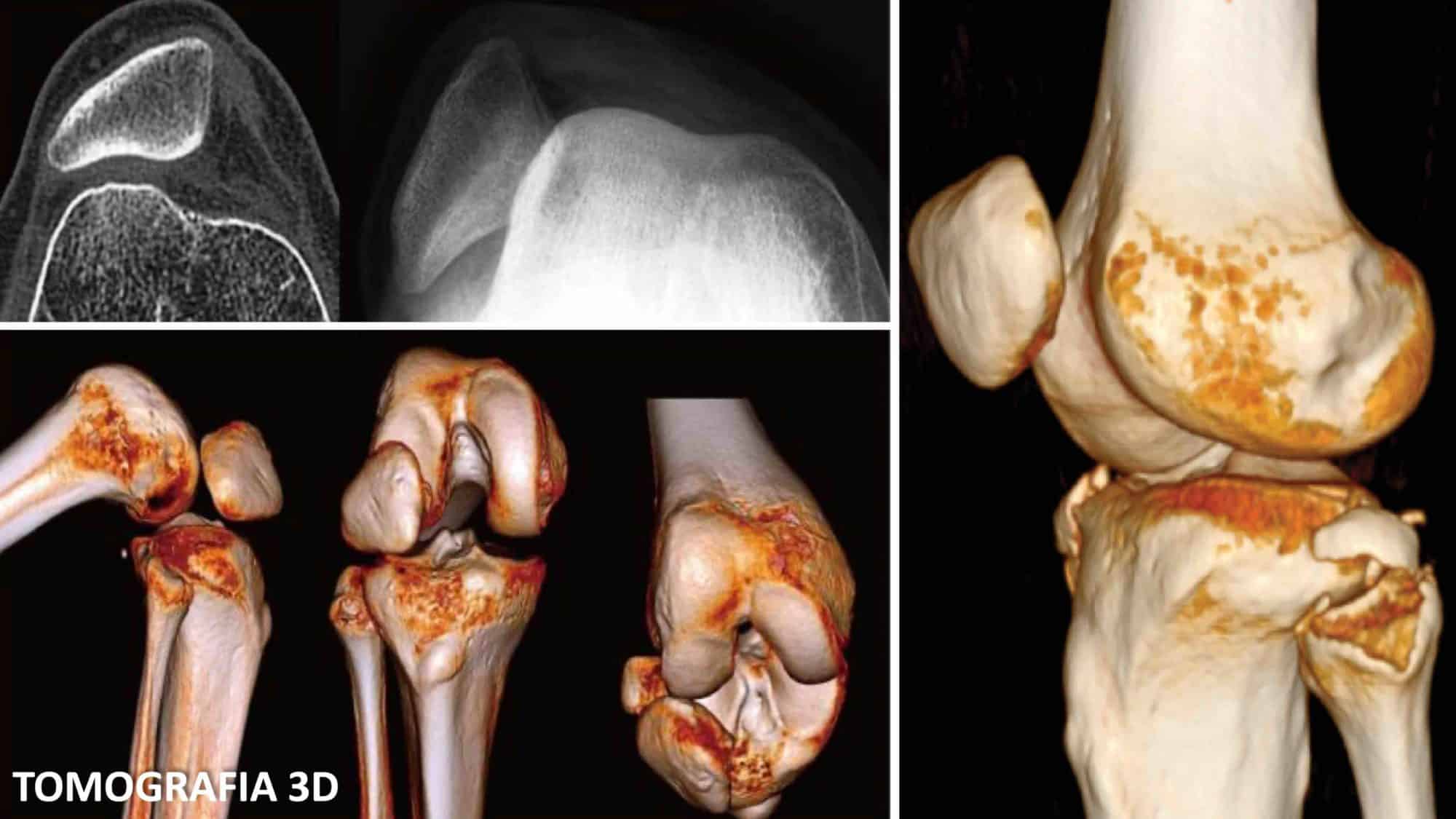 TOMOGRAFIA COMPUTADORIZADA DO JOELHO