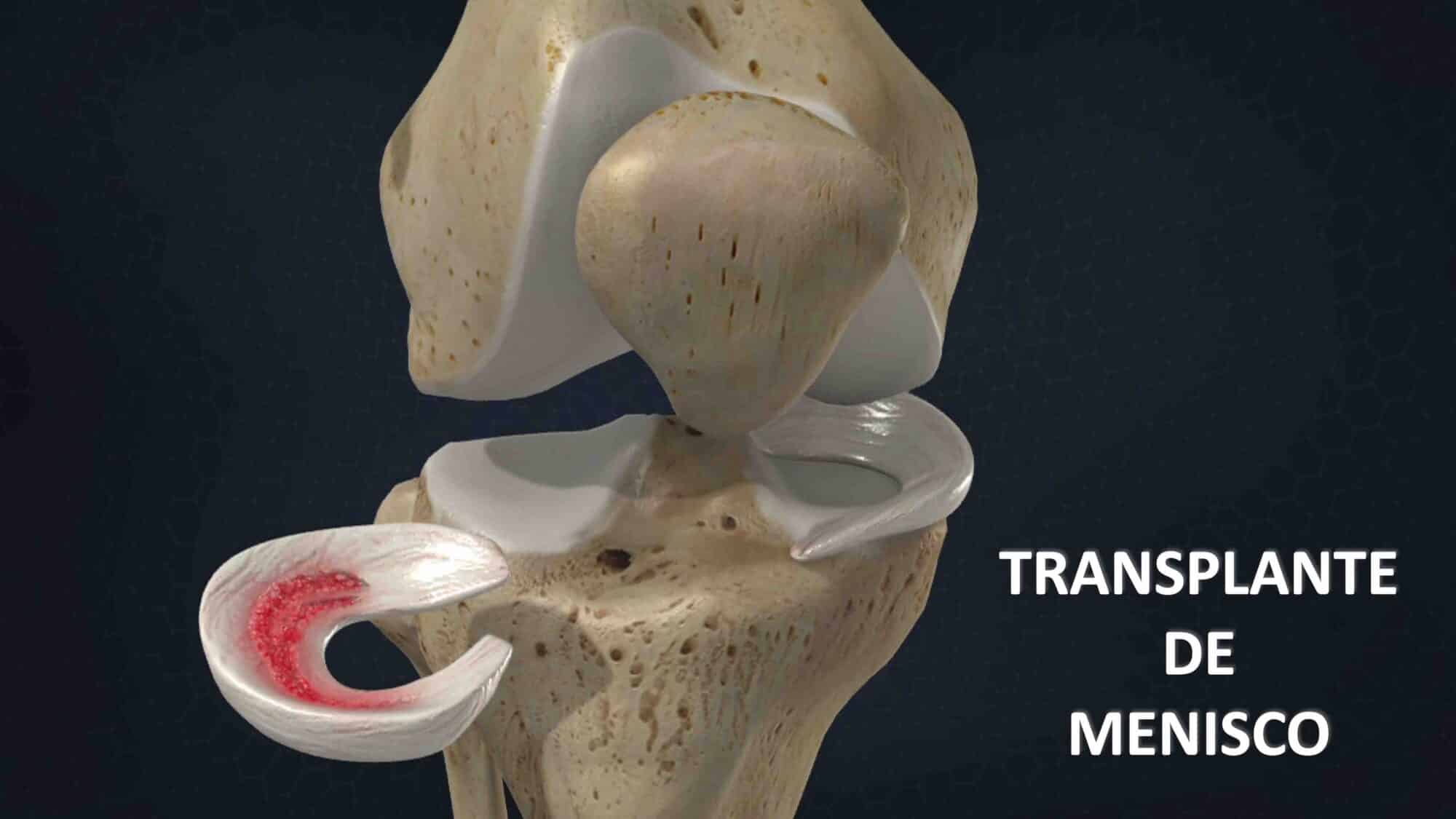 TRANSPLANTE MENISCAL