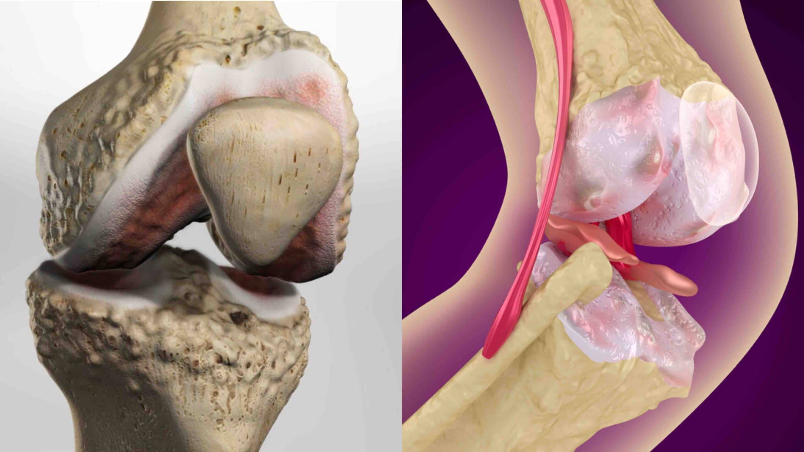 OSTEÓFITOS NO JOELHO