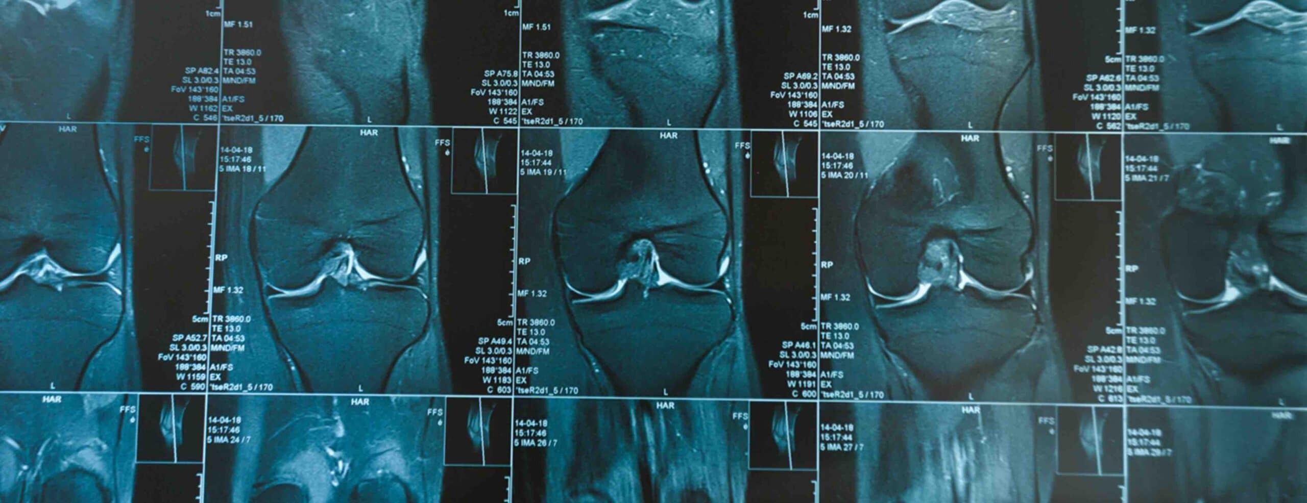 EXAME DE RESSONÂNCIA MAGNÉTICA DO JOELHO