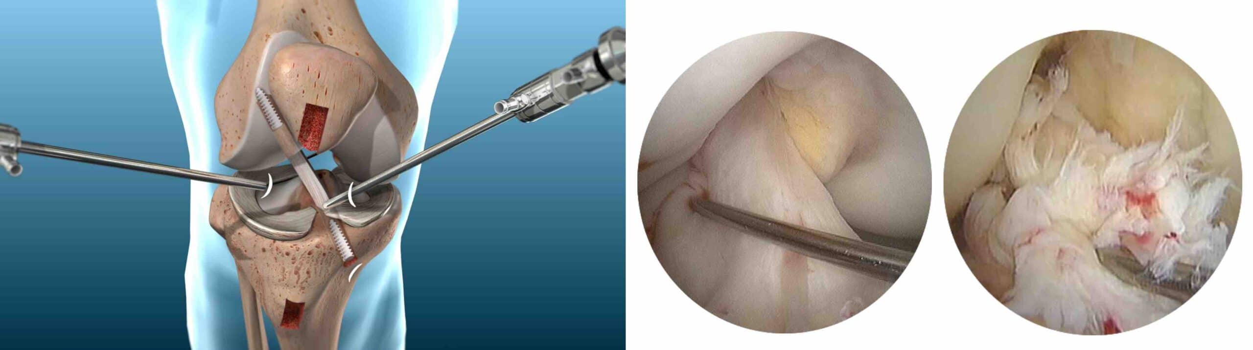 LIGAMENTO CRUZADO ANTERIOR