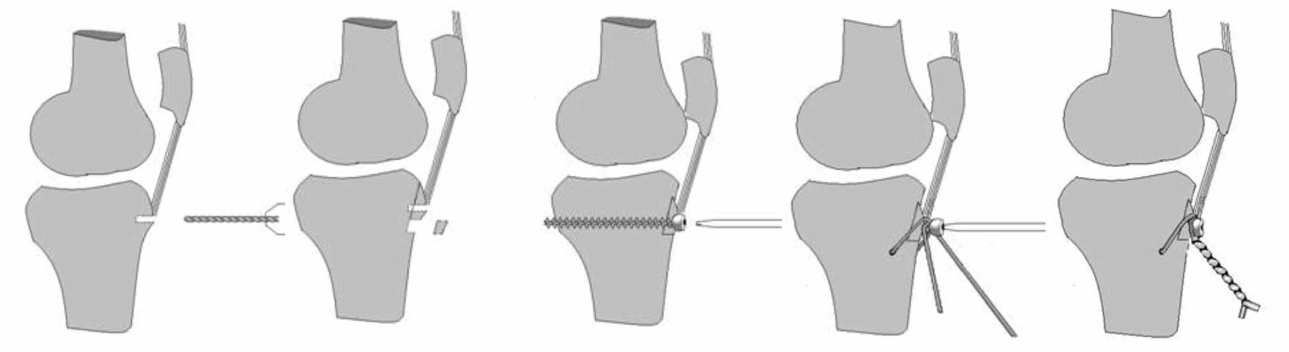 CIRURGIA PARA PATELA ALTA