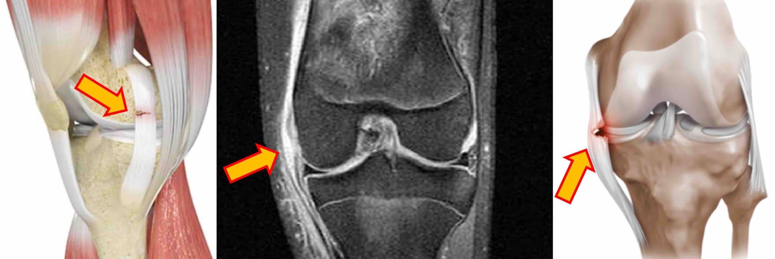 LIGAMENTO COLATERAL MEDIAL JOELHO