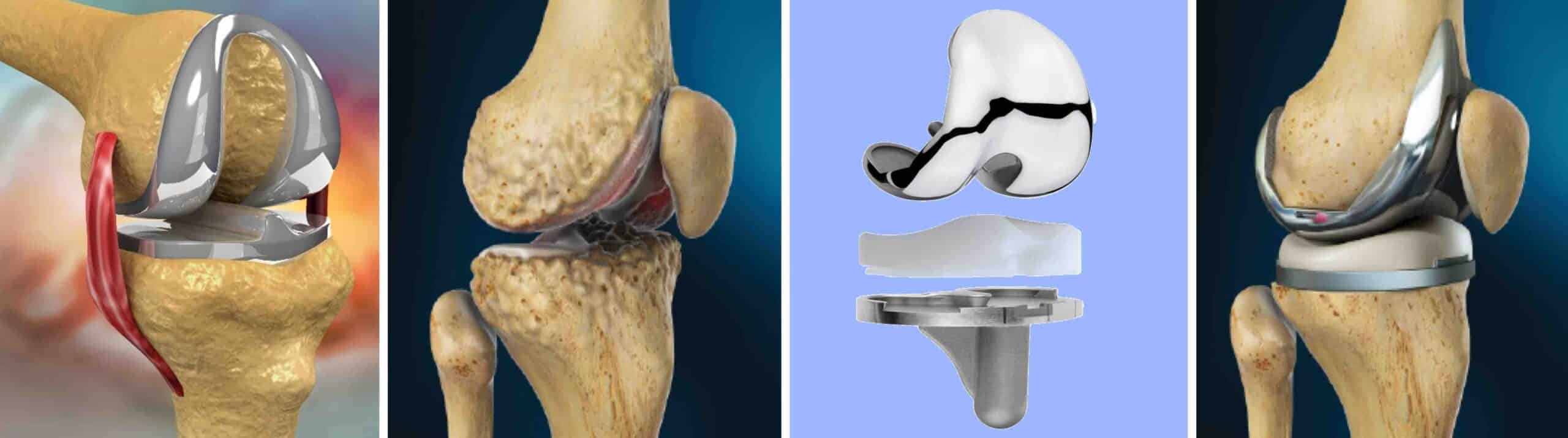 CIRURGIA ROBÓTICA DE JOELHO