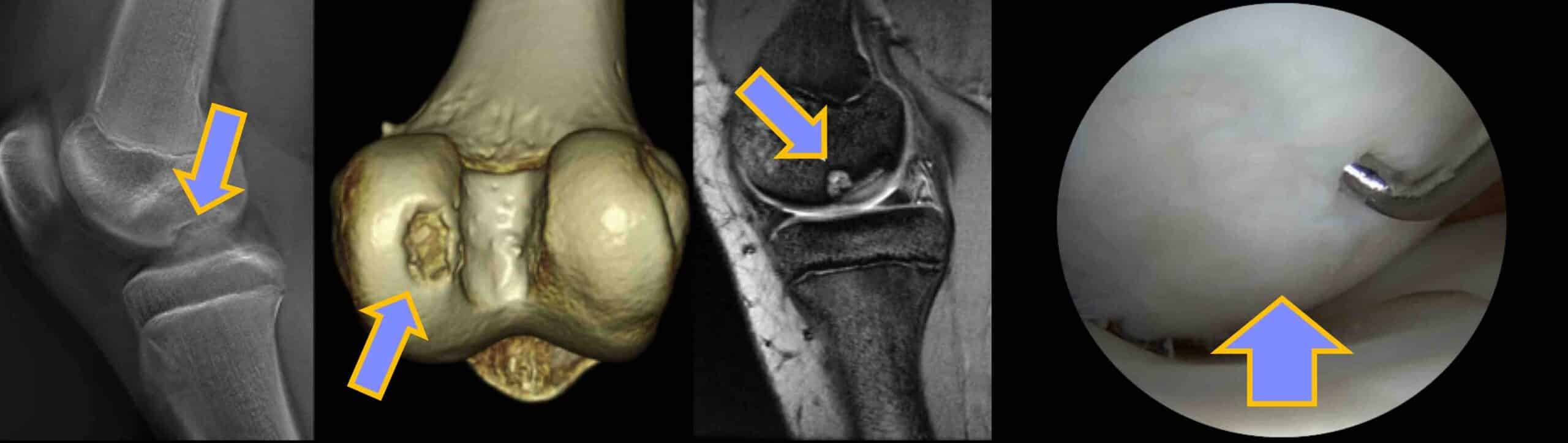 OSTEOCONDRITE DISSECANTE DO JOELHO