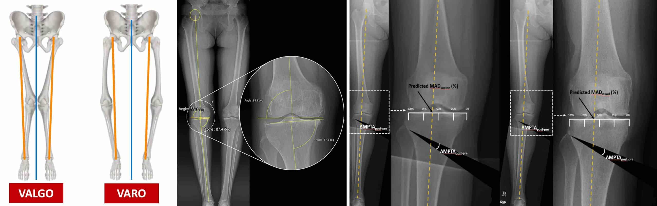 OSTEOTOMIA JOELHO