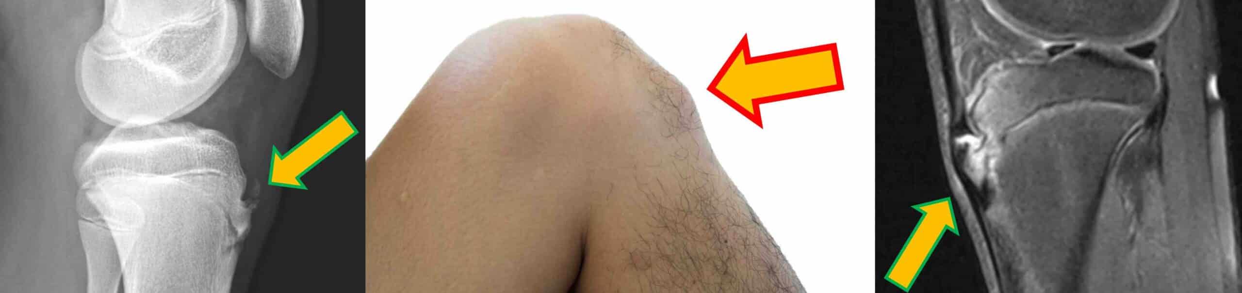 DOENÇA DE OSGOOD-SCHLATTER