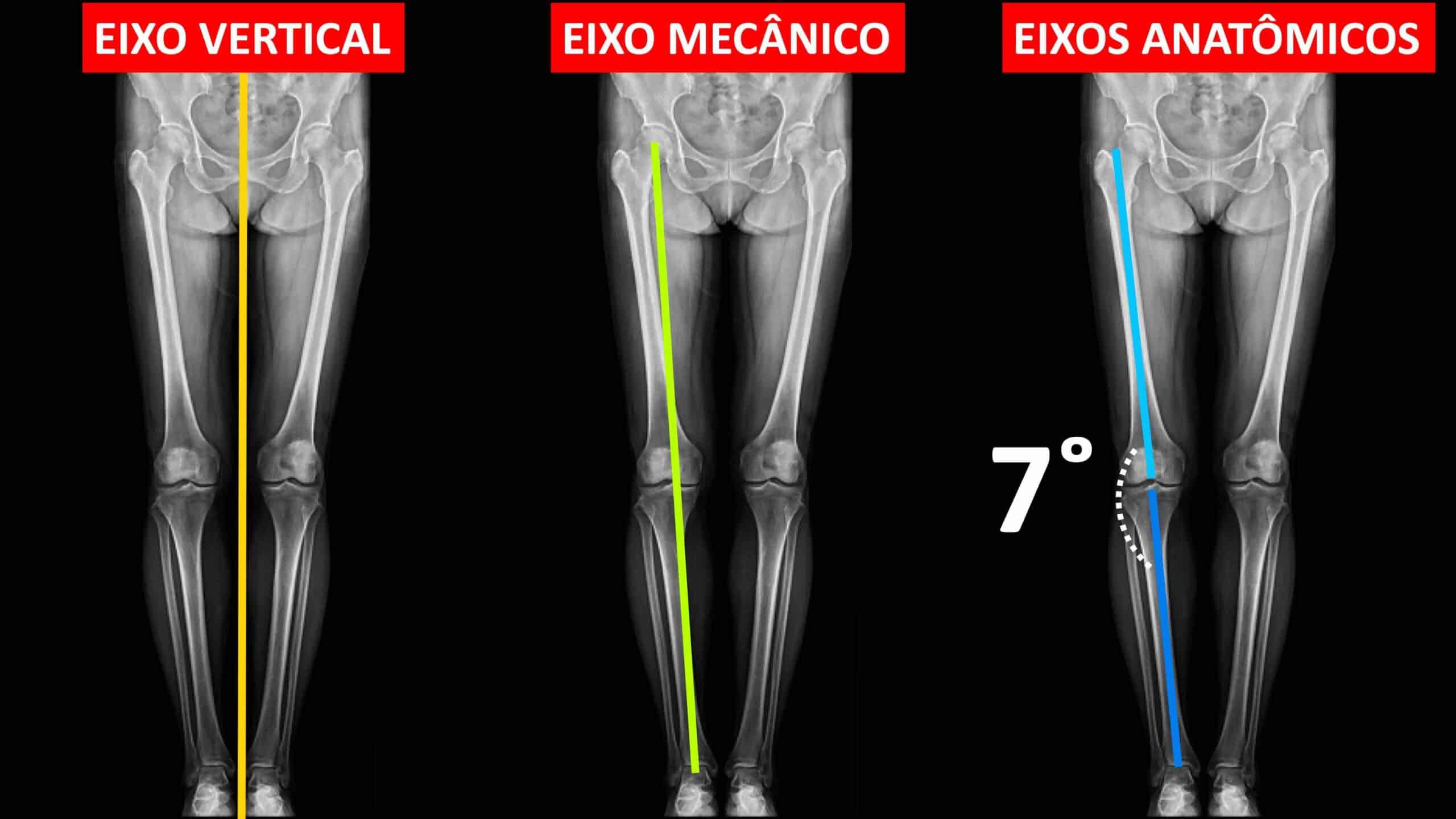 JOELHO VARO E JOELHO VALGO - EIXOS