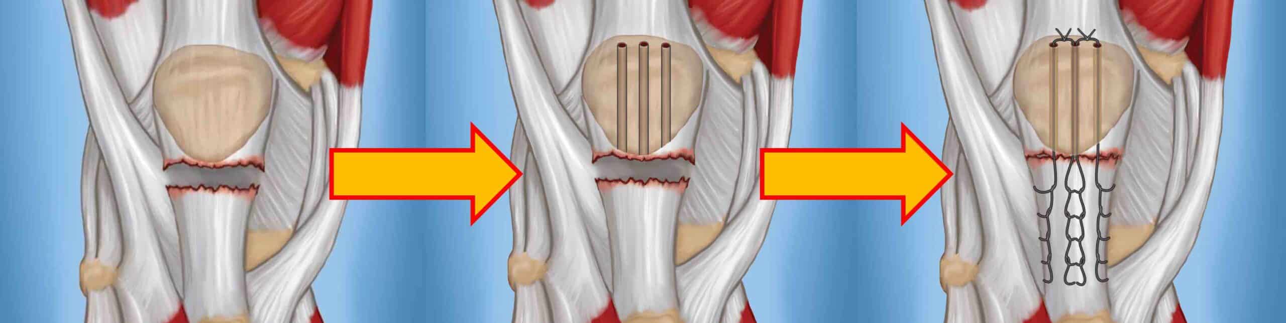 CIRURGIA DA ROTURA DO TENDÃO PATELAR