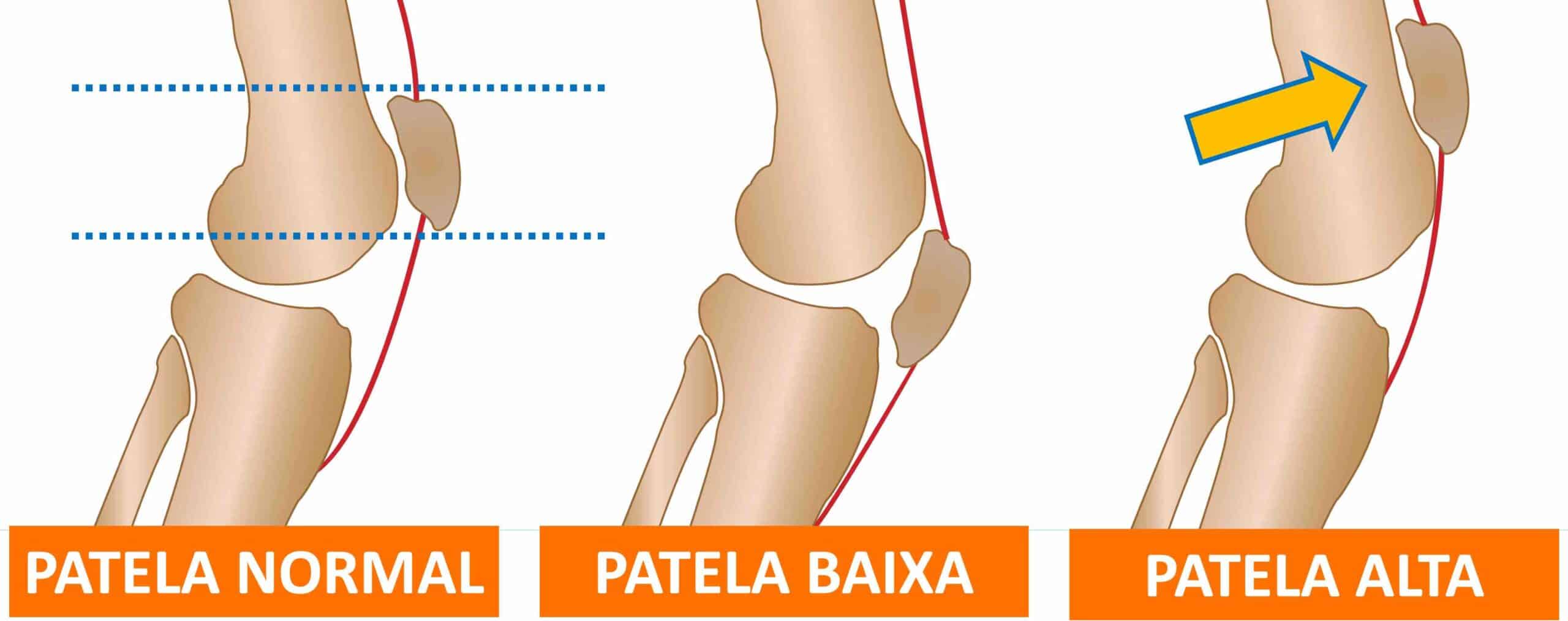 ALTURA DA PATELA NO JOELHO