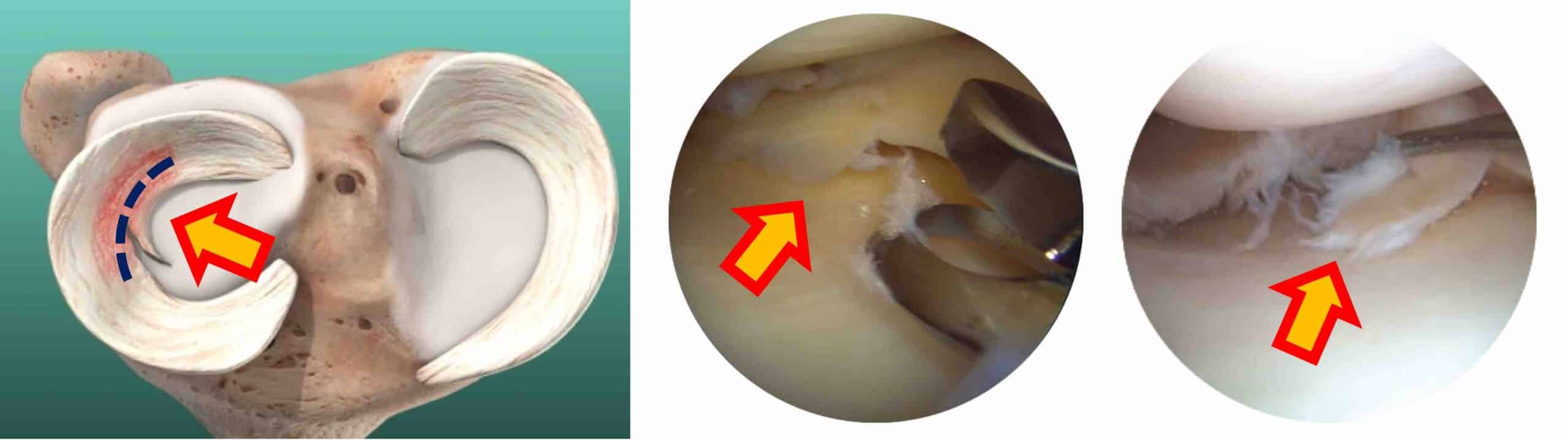 CIRURGIA DE MENISCECTOMIA