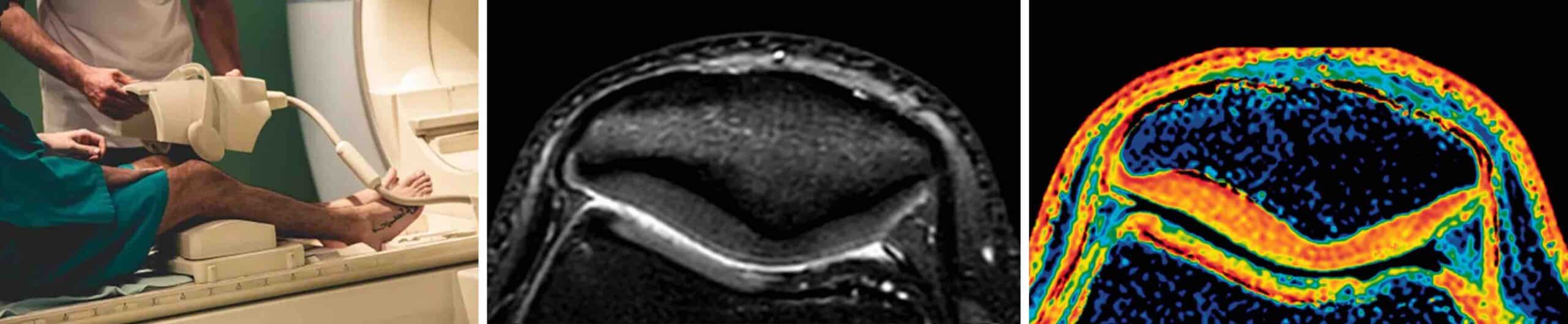 RESSONÂNCIA PATELOFEMORAL