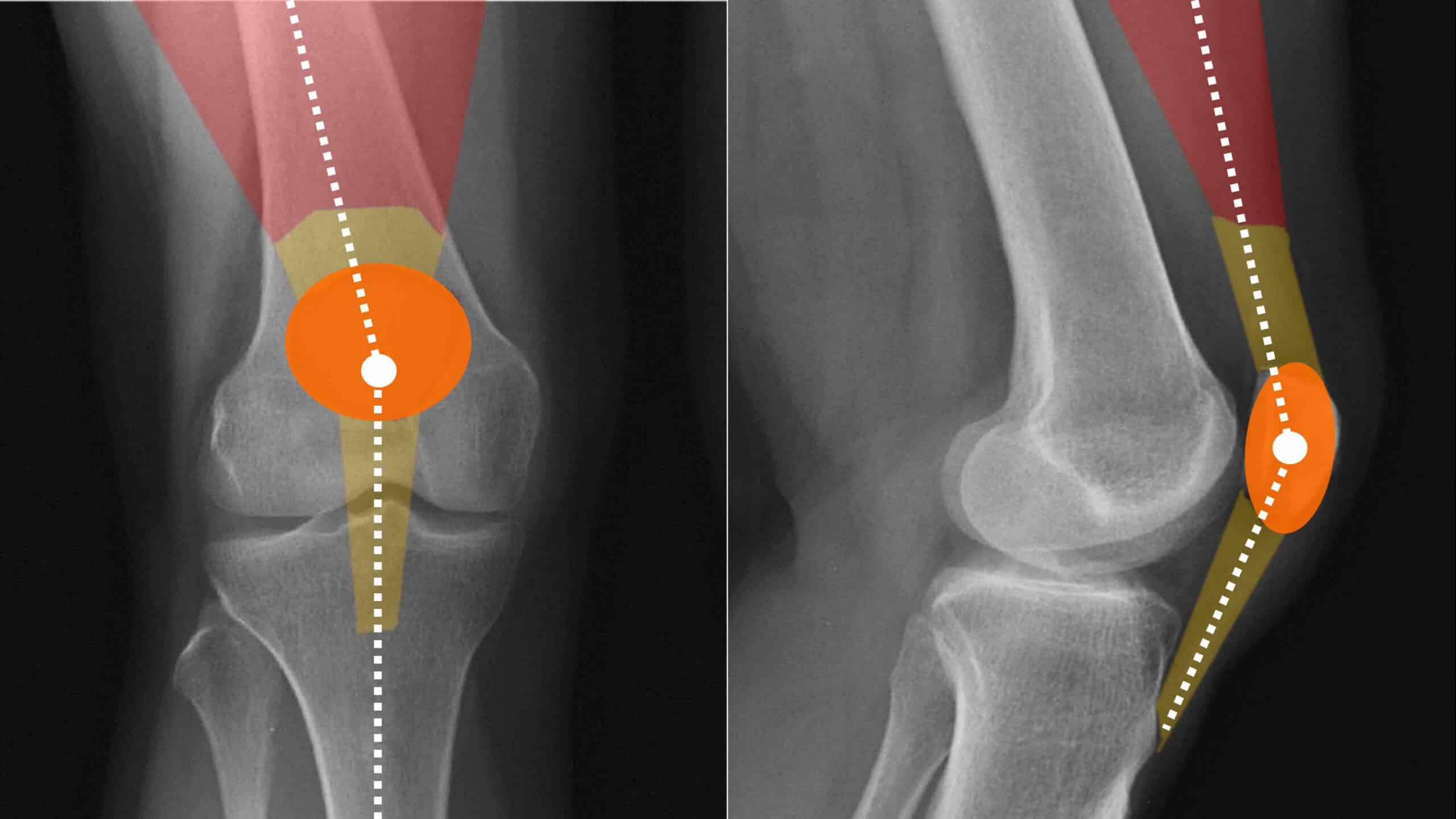 HIPERSOLICITAÇÃO DO MECANISMO EXTENSOR