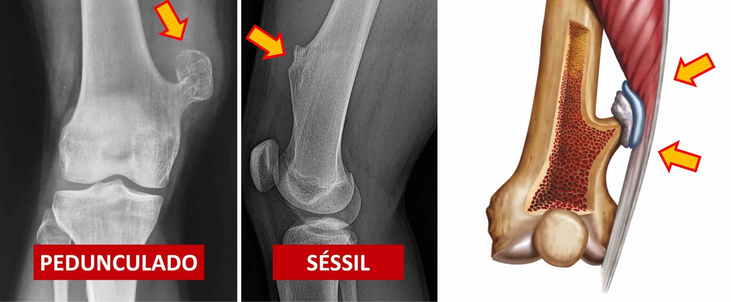 OSTEOCONDROMA JOELHO