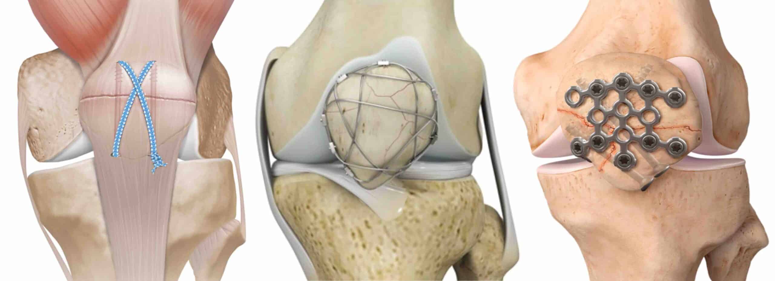 CIRURGIA FRATURA PATELA