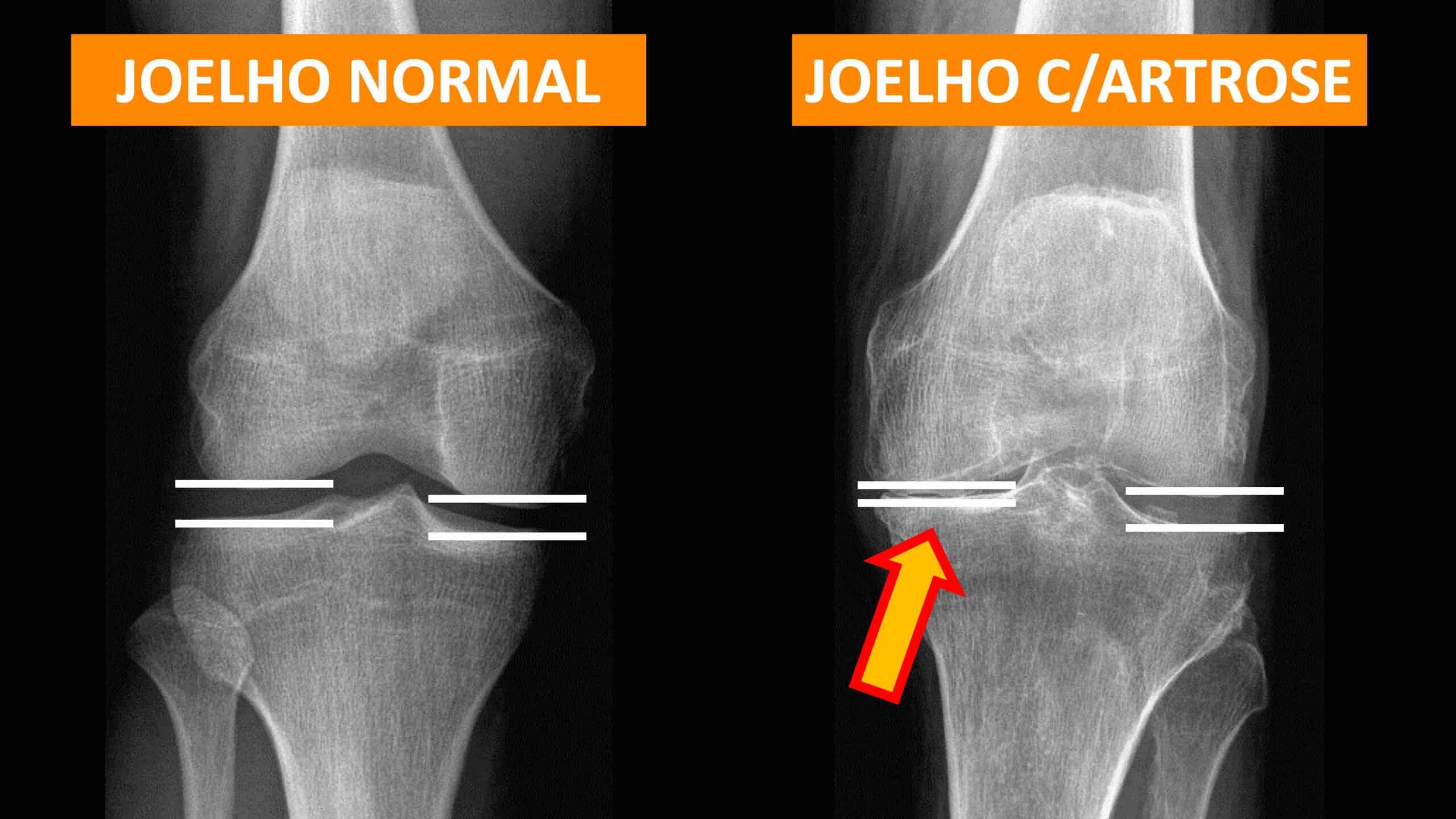 REDUÇÃO ESPAÇO ARTICULAR JOELHO