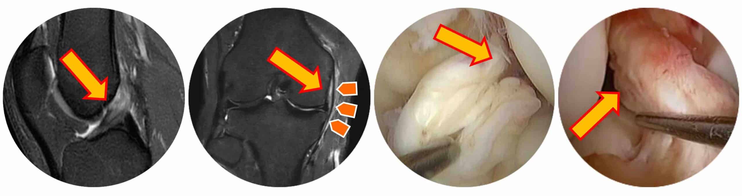 ROMPIMENTO LIGAMENTO JOELHO