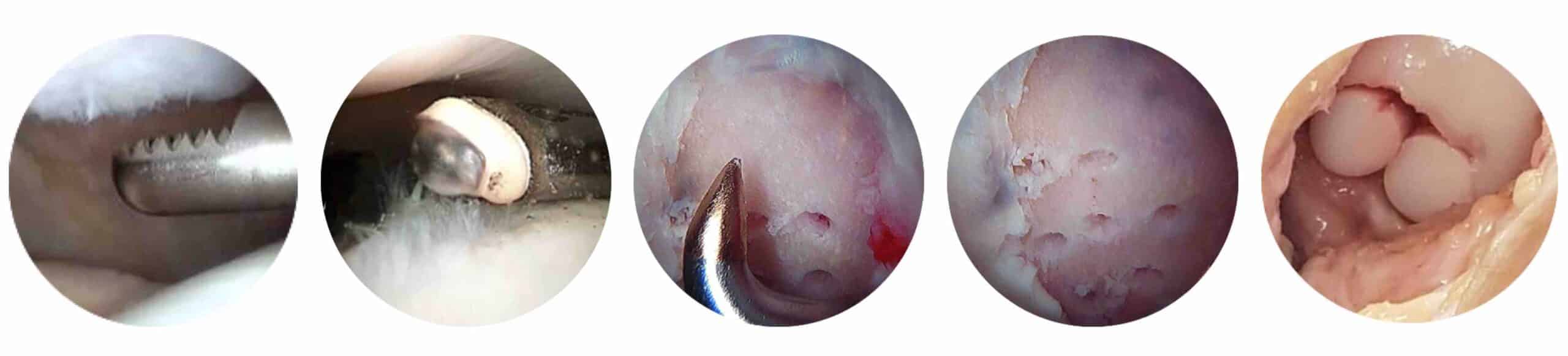 CIRURGIA CARTILAGEM JOELHO