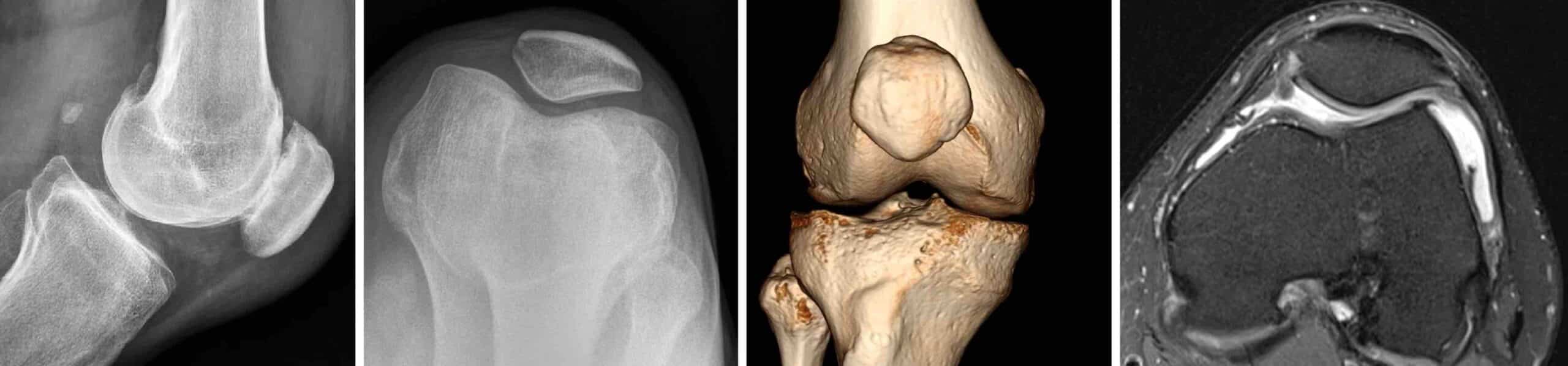 EXAMES DE IMAGEM PATELOFEMORAL