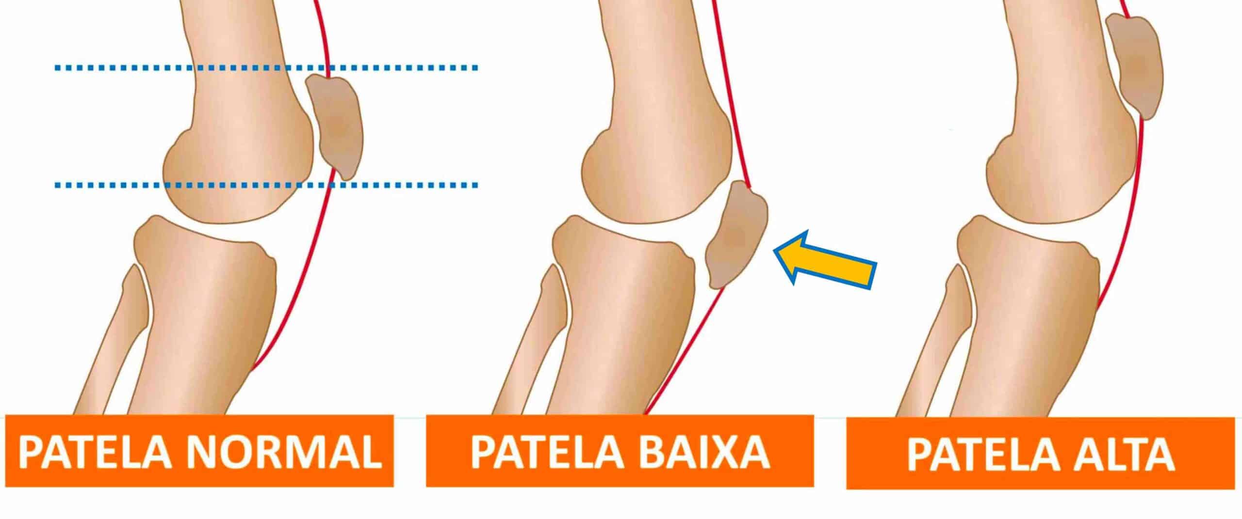 JOELHO COM PATELA BAIXA