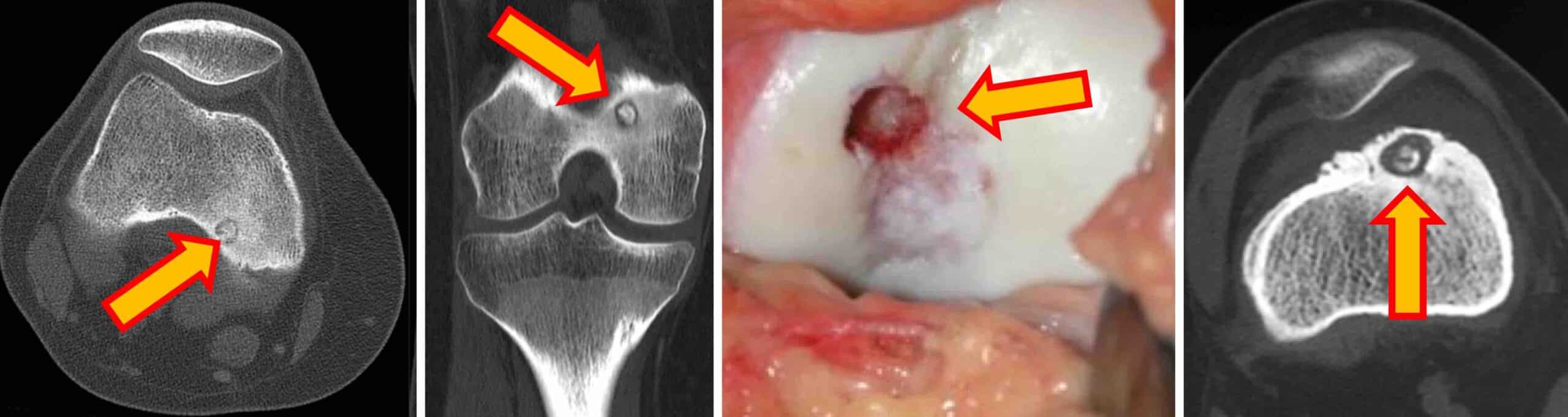 OSTEOMA OSTEÓIDE JOELHO