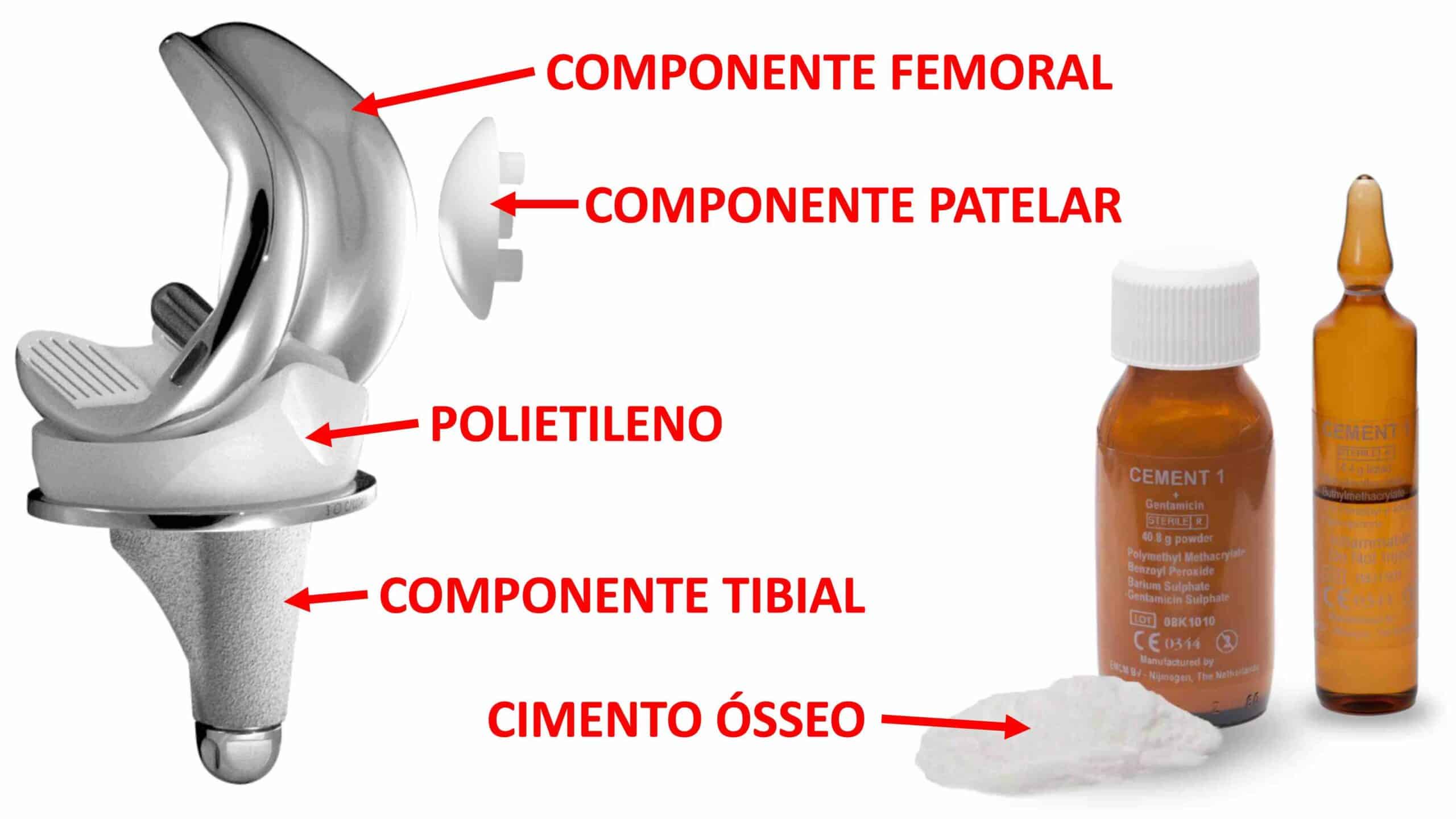 COMPONENTES PRÓTESE DE JOELHO COMPONENTES PRÓTESE DE JOELHO