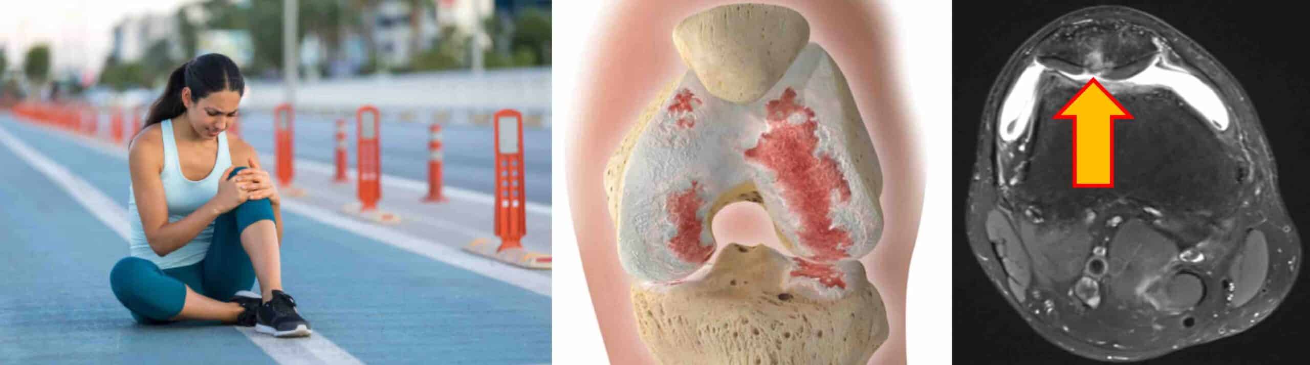 EROSÃO CONDRAL PROFUNDA JOELHO EROSÃO CONDRAL PROFUNDA JOELHO