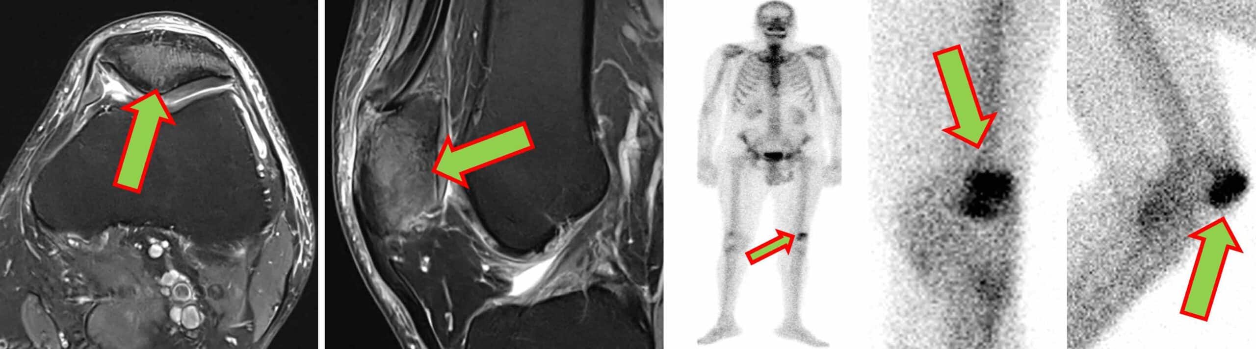 ANATOMIA DO JOELHO 32
