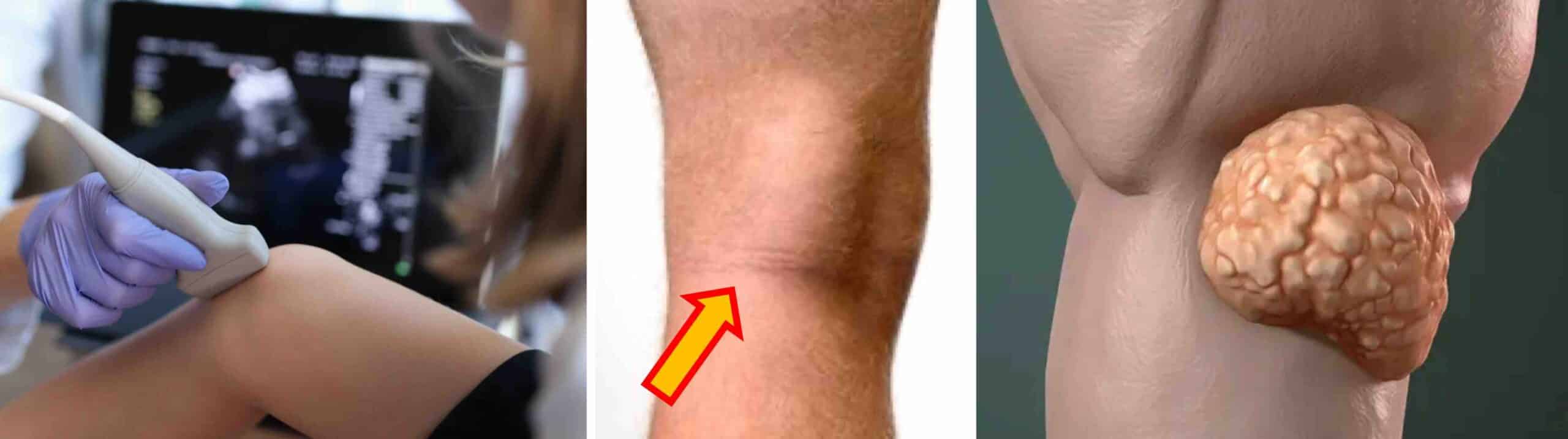 LIPOMA JOELHO LIPOMA JOELHO