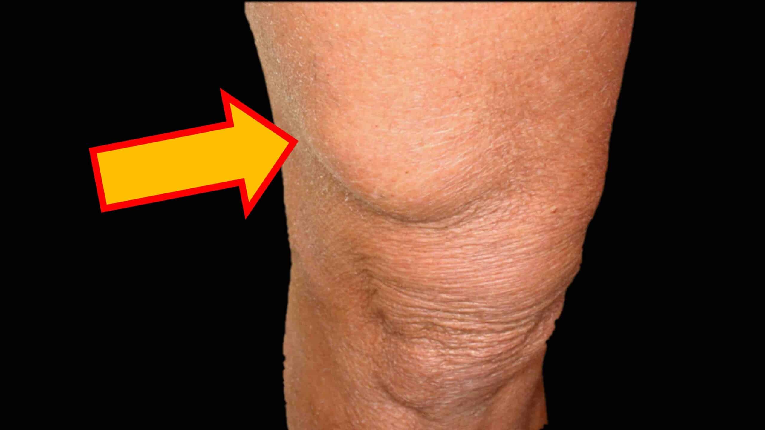 LIPOMA NO JOELHO LIPOMA NO JOELHO