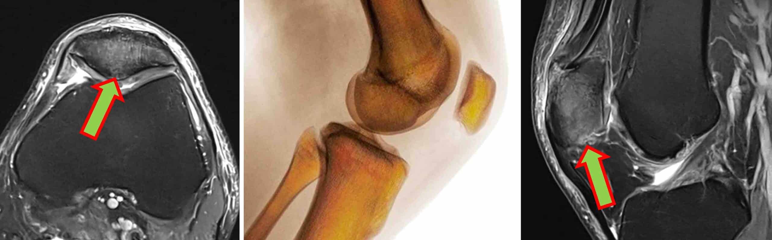 OSTEONECROSE PATELA OSTEONECROSE PATELA