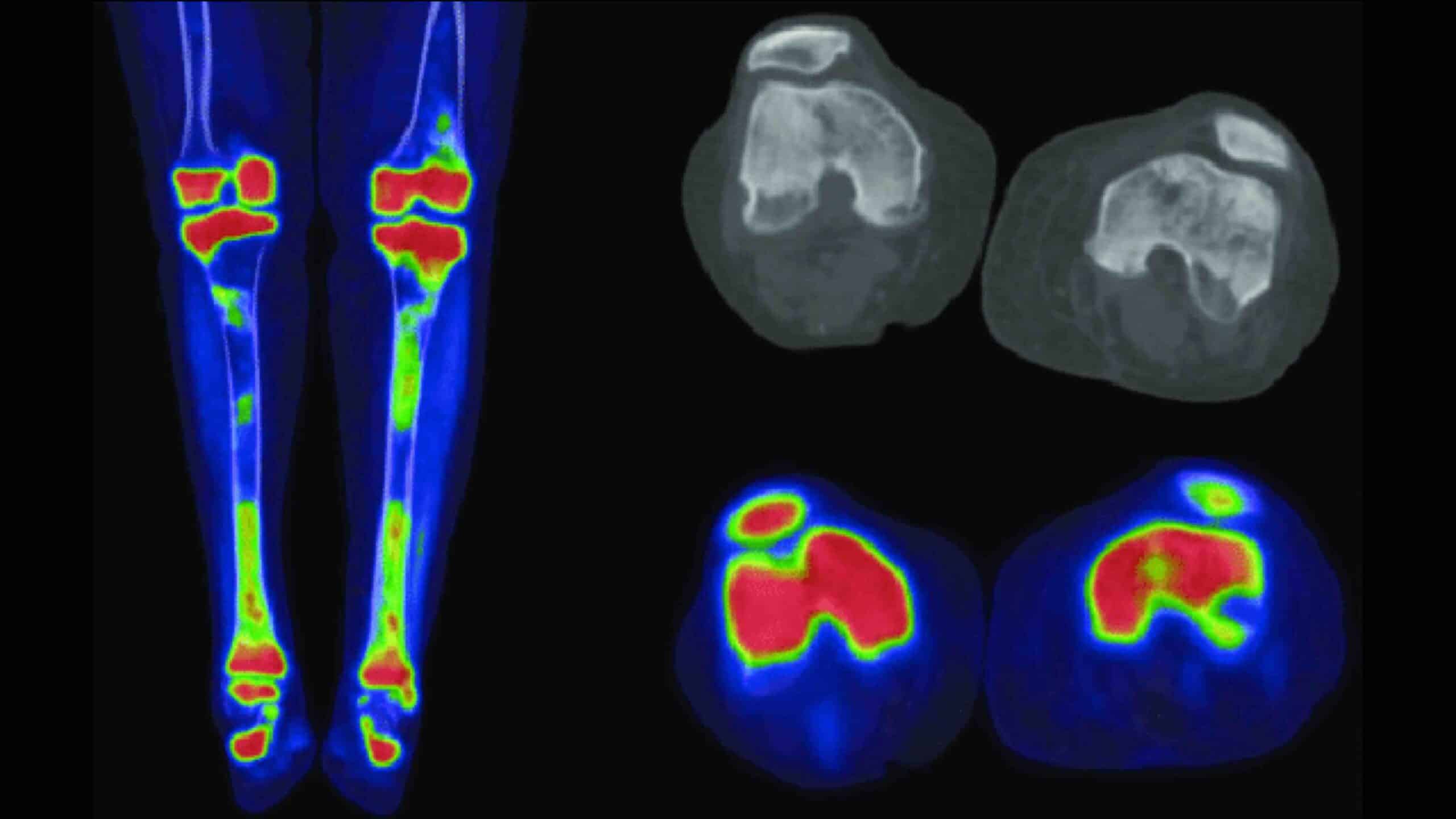 PET SCAN DO JOELHO PET SCAN DO JOELHO