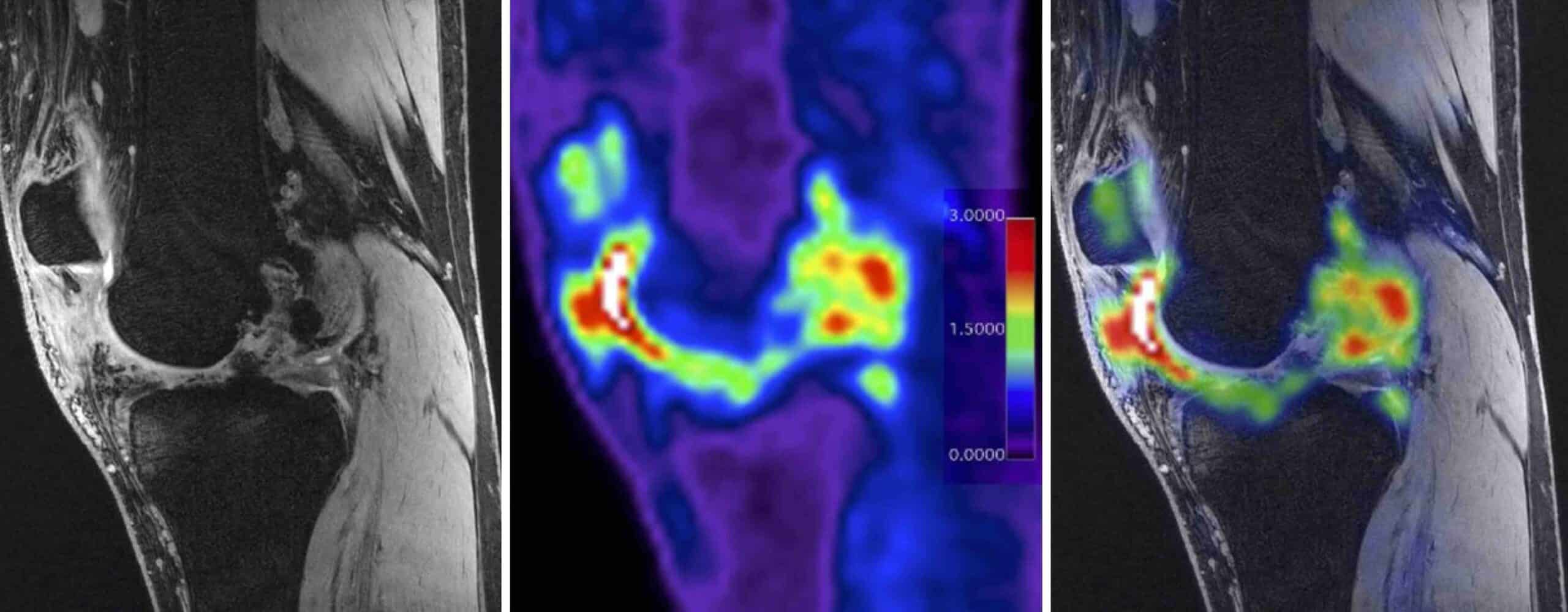 PET SCAN JOELHO PET SCAN JOELHO