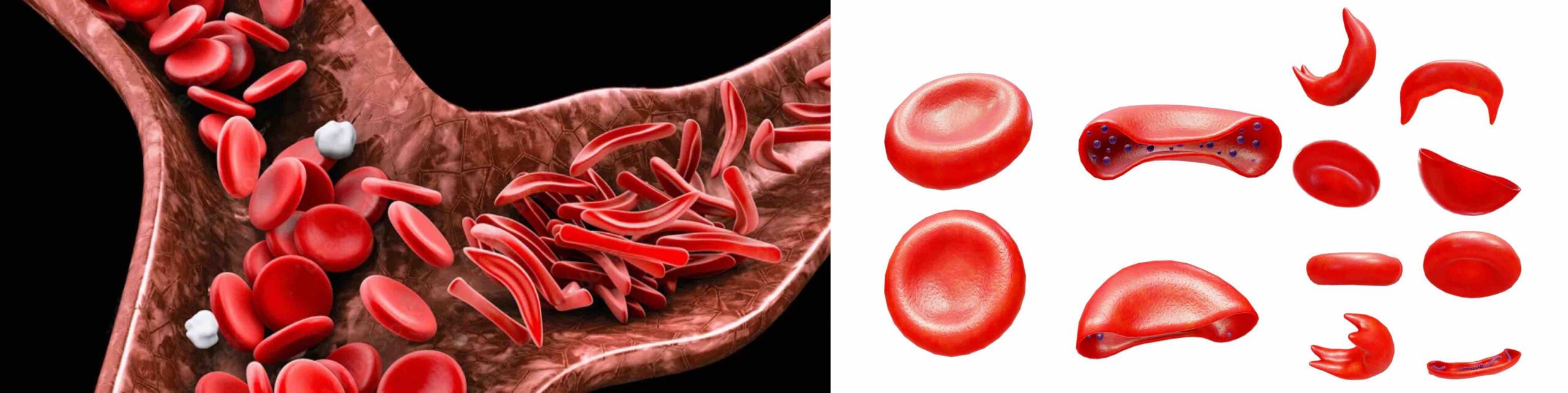 ANEMIA FALCIFORME DOR JOELHO ANEMIA FALCIFORME DOR JOELHO