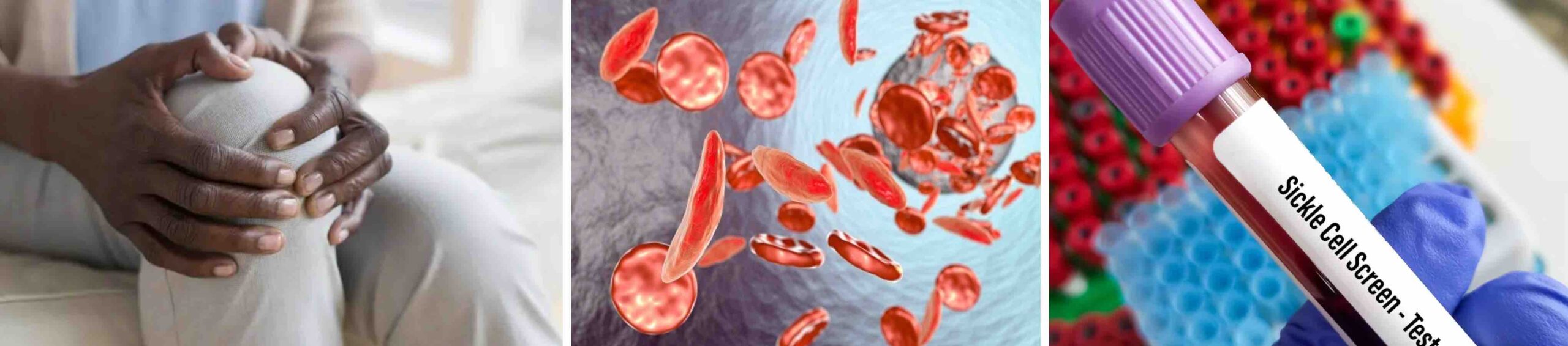 ANEMIA FALCIFORME E DOR NO JOELHO ANEMIA FALCIFORME E DOR NO JOELHO