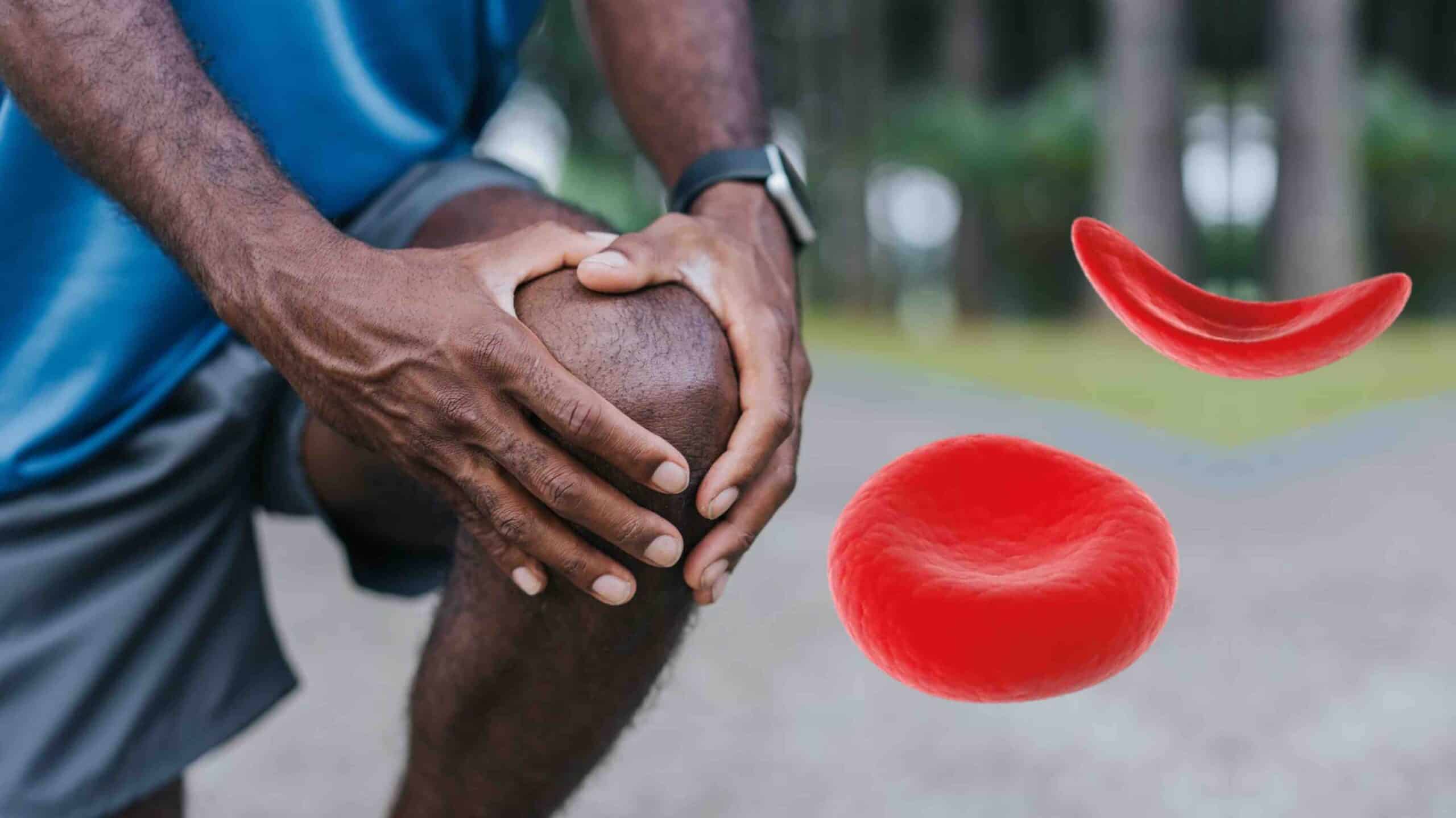 DOR NO JOELHO E ANEMIA FALCIFORME DOR NO JOELHO E ANEMIA FALCIFORME
