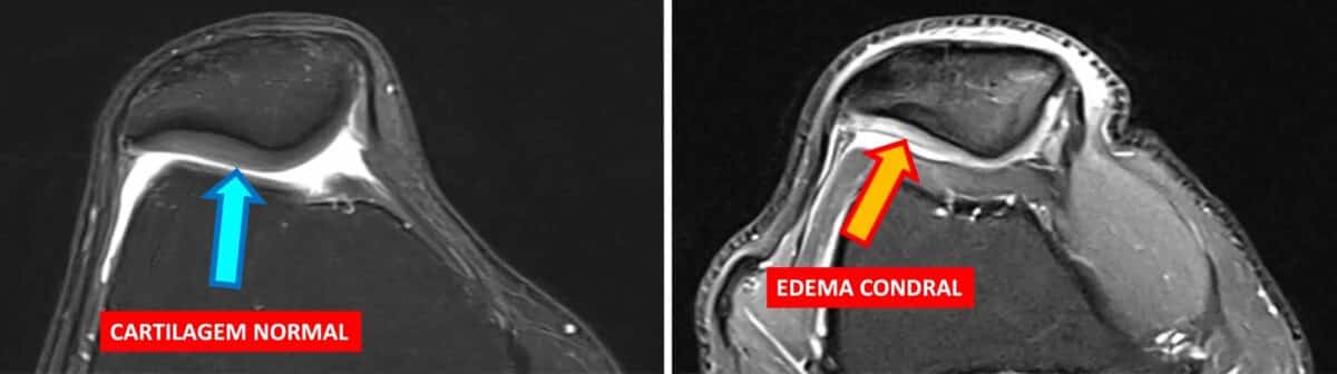 Edema condral no Joelho | Clínica do Joelho