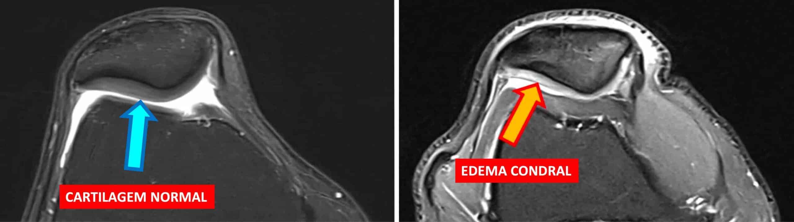 EDEMA CONDRAL JOELHO EDEMA CONDRAL JOELHO