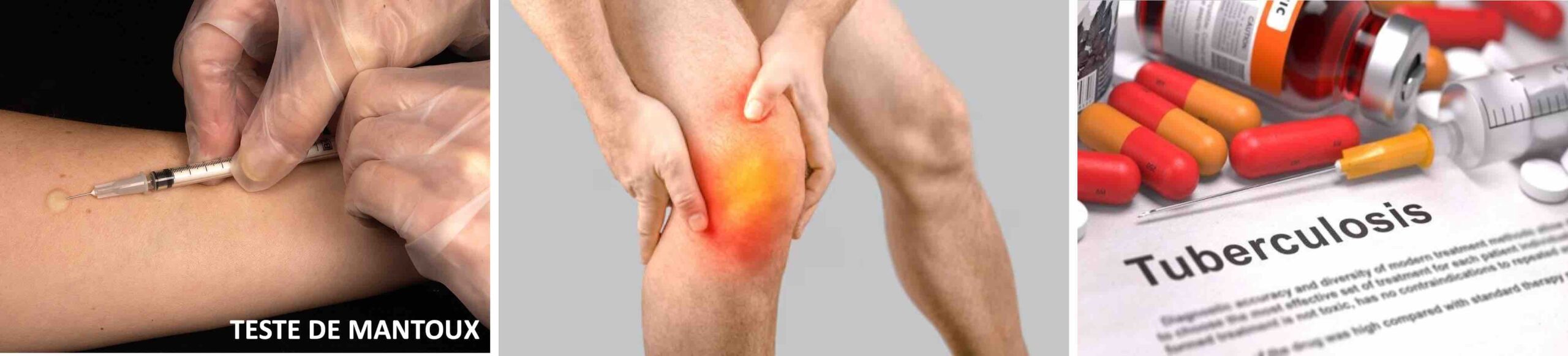 JOELHO TUBERCULOSE JOELHO TUBERCULOSE