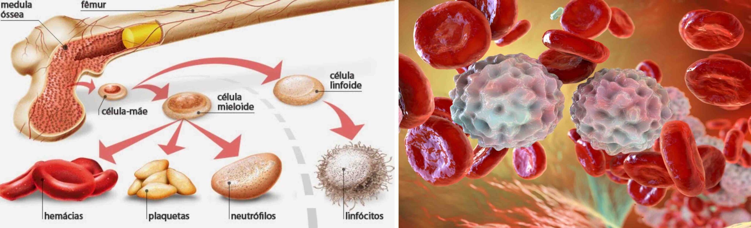 LEUCEMIA E DOR NO JOELHO LEUCEMIA E DOR NO JOELHO