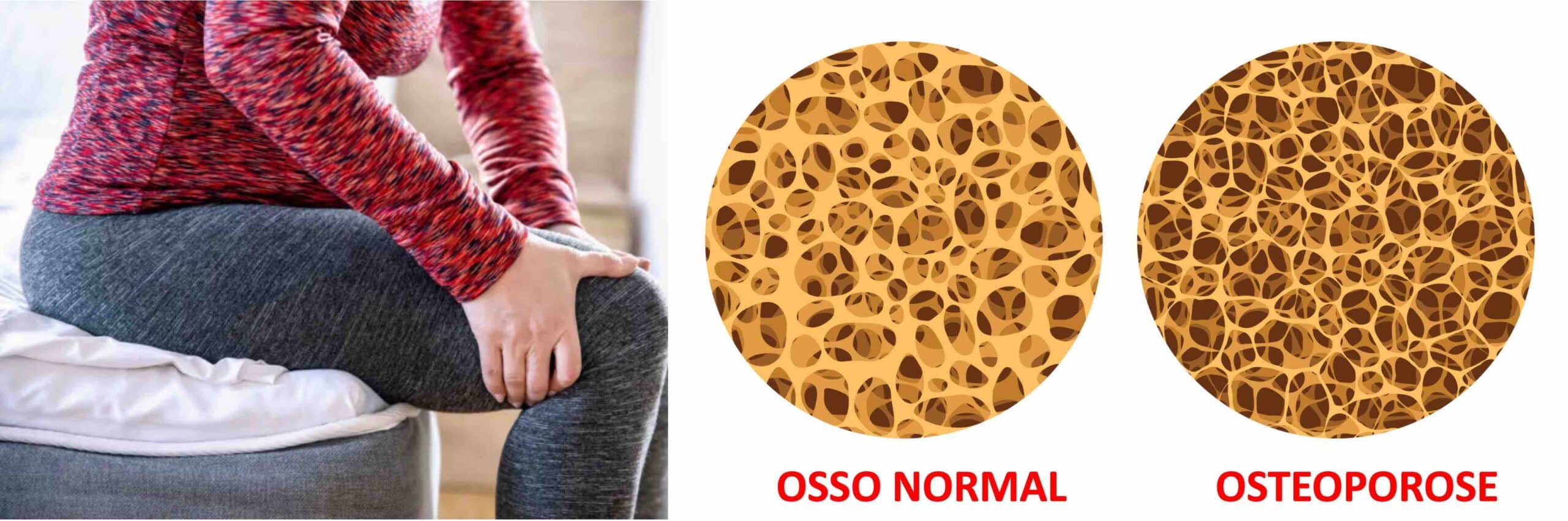 OSTEOPOROSE JOELHO OSTEOPOROSE JOELHO