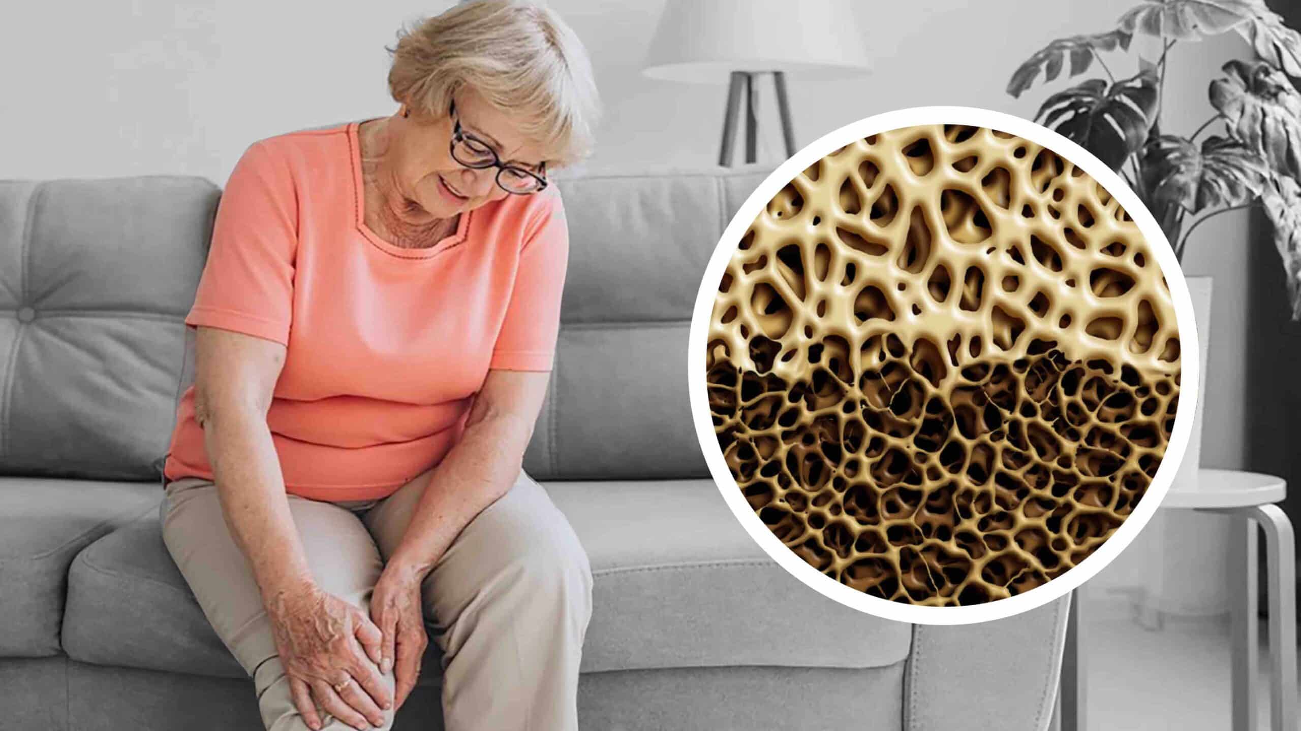 OSTEOPOROSE NO JOELHO OSTEOPOROSE NO JOELHO