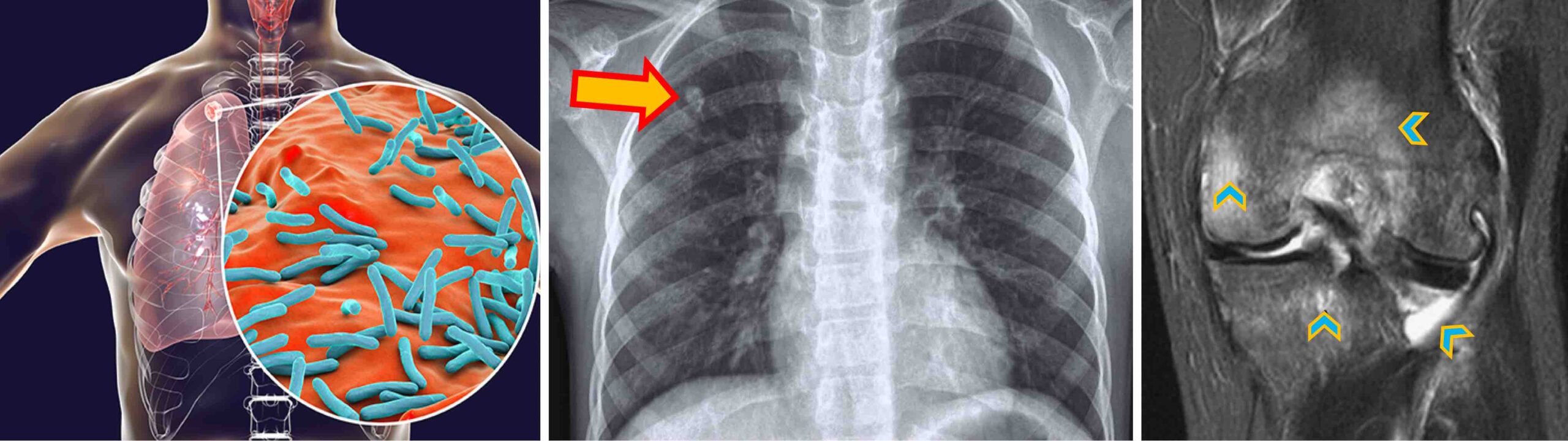 TUBERCULOSE JOELHO TUBERCULOSE JOELHO