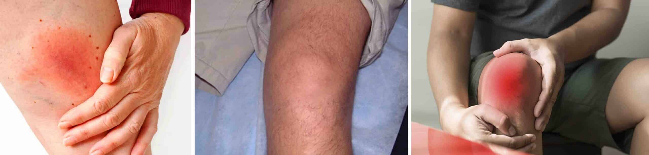 ARTRITE DE LYME NO JOELHO