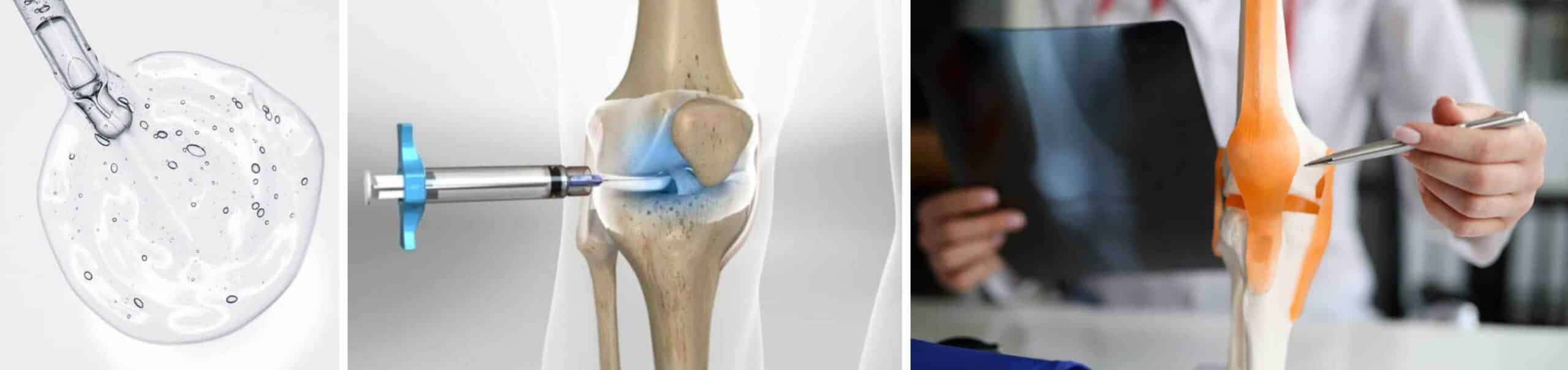PREENCHIMENTO ARTICULAR ÁCIDO HIALURÔNICO PREENCHIMENTO ARTICULAR ÁCIDO HIALURÔNICO