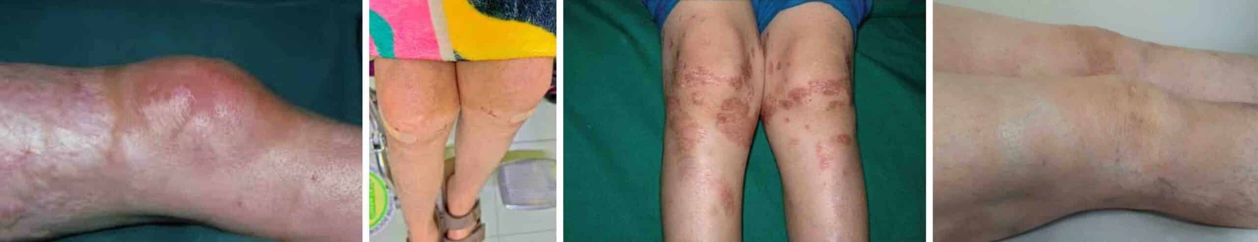 ESCLERODERMIA JOELHO